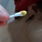 【画像】ワキガ体質の耳垢はこれ！軽度から重度のワキガ度チェック