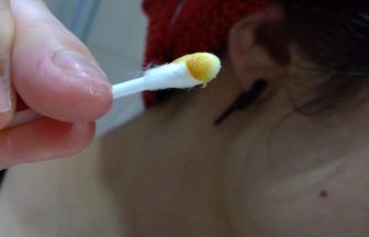 【画像】ワキガ体質の耳垢はこれ！軽度から重度のワキガ度チェック