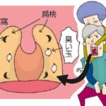 【画像】膿栓の取り方６選と対策！見えない膿栓も口臭原因！？