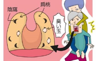 【画像】膿栓の取り方６選と対策！見えない膿栓も口臭原因！？